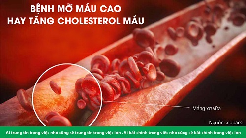 Bệnh mỡ máu cao xuất hiện khi có sự tăng bất thường về các chỉ số cholesterol